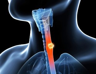 tumeurs oesophage  rogné redim.jpg