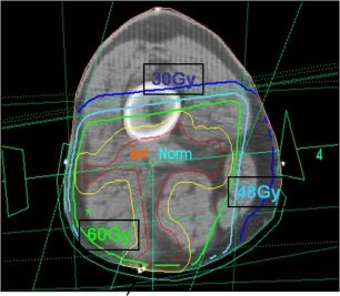 image radiotherapie sarcome schubert site .jpg
