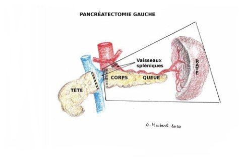 Pancreatectomie gauche CH_DS redim 500x325_2.jpg