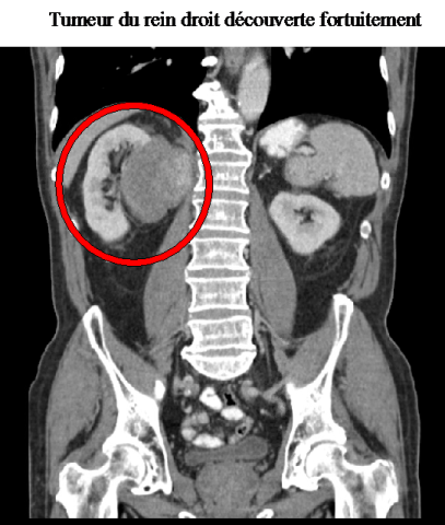 TUMEUR DU REIN_0.png